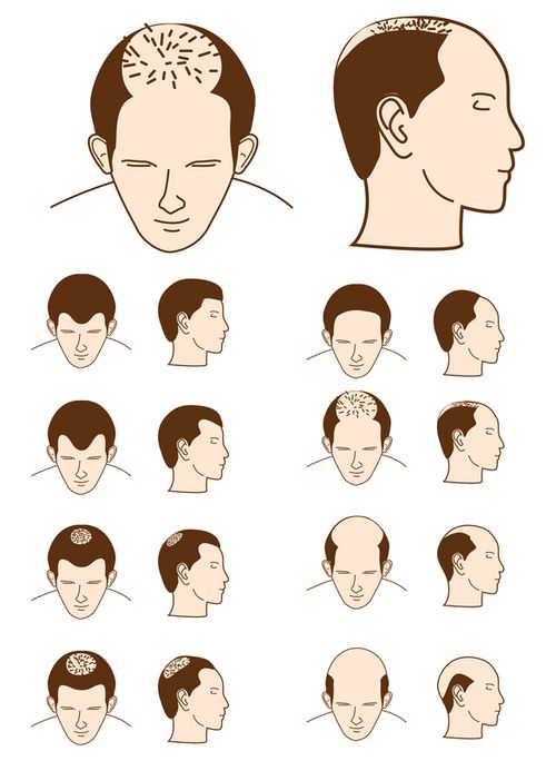 diversos estagios de alopecia
