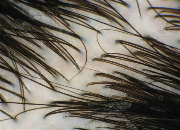 imagem de couro cabeludo em exame de tricoscopia